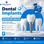 dental implant in indirapuram.jpg